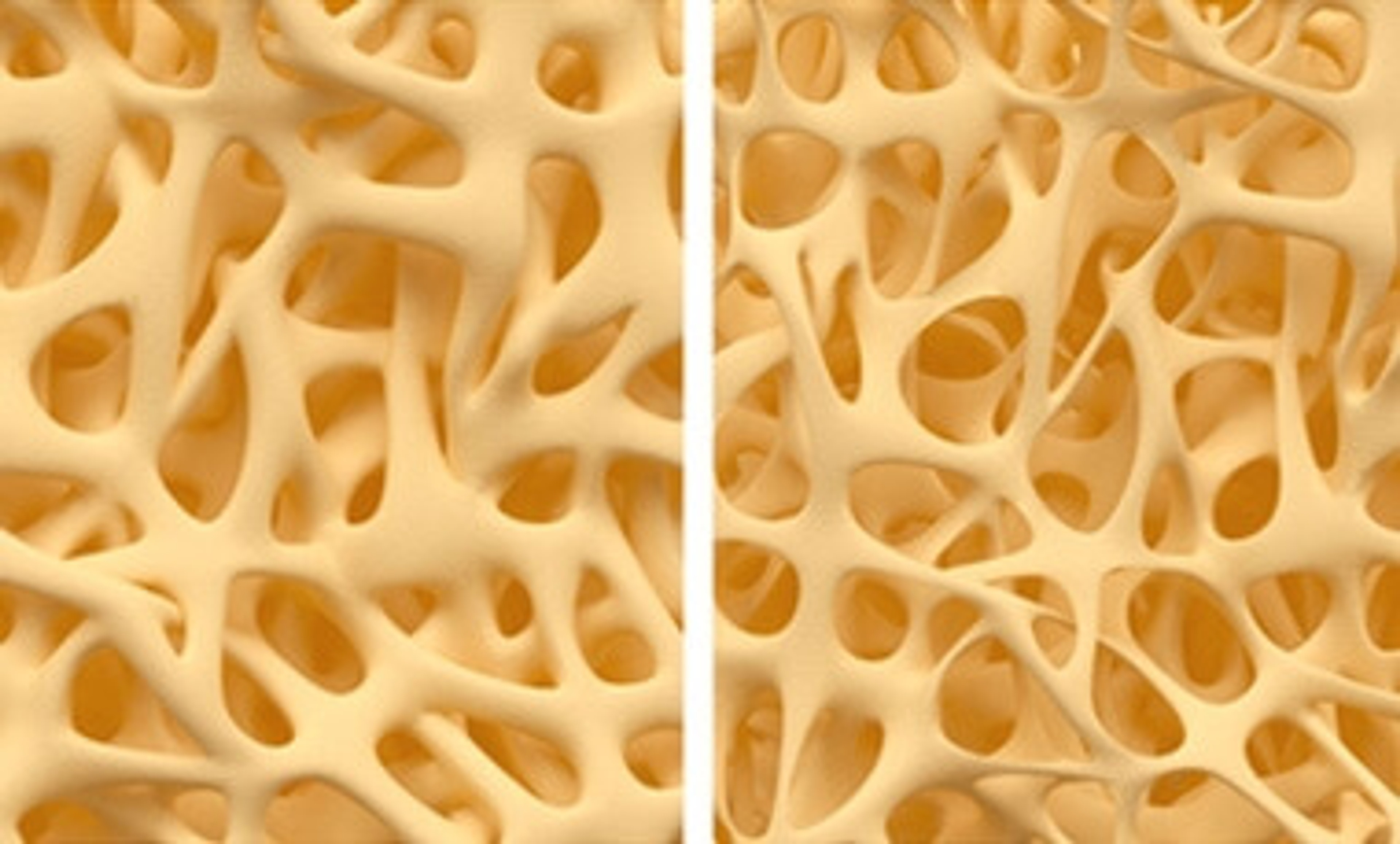 osteoporose.jpg